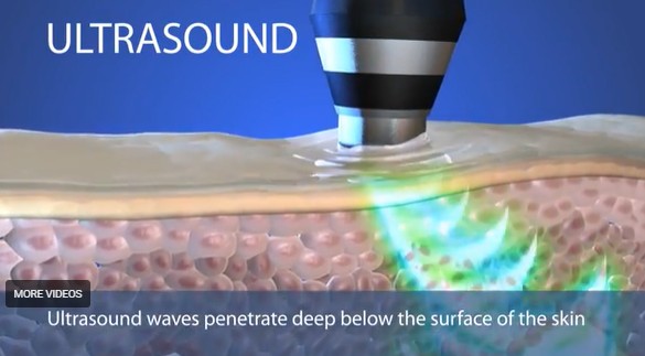  Geneo Ultrasound Technology