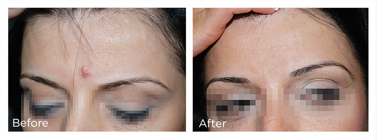 FreezePen-BA-Website-Hemangioma-Web