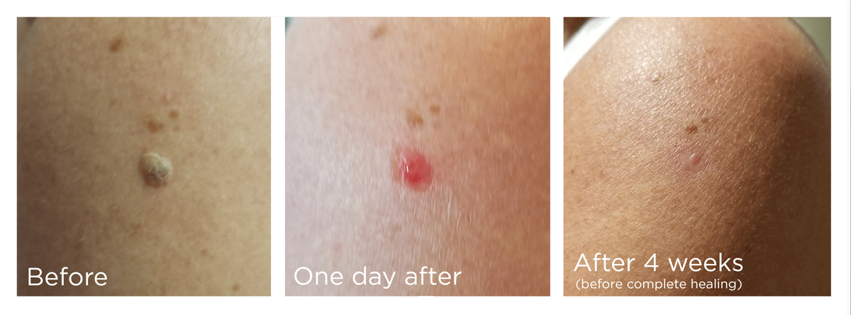 FreezePen-BA-Website-Skin-New-Web-v2