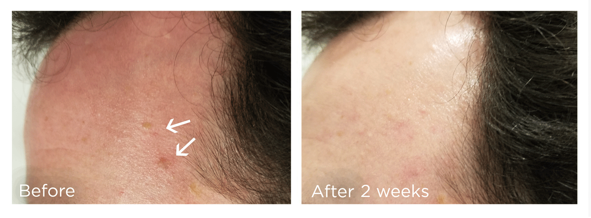 FreezePen-BA-Website-Skin-New3-WEB-V2