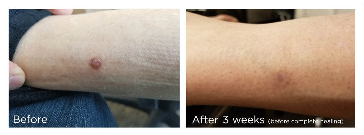 FreezePen-BA-Website-Skin-New5-Web-V2