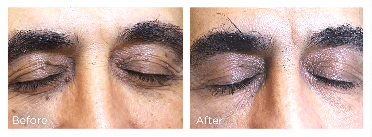 FreezePen-BA-Website-Skin-Tag-Web-1