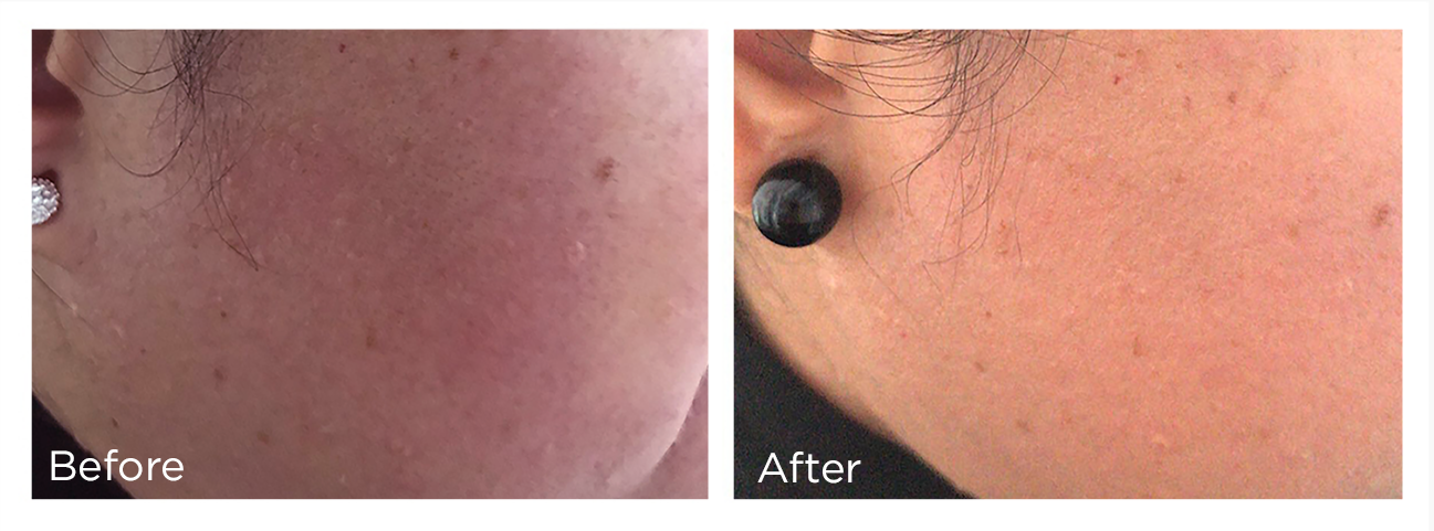 FreezePen-BA-Website-cheek-1-Web