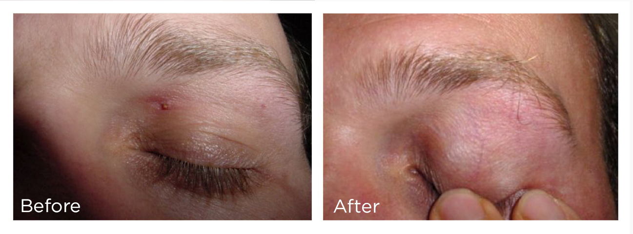 FreezePen-BA-Website-eyewart-1-Web