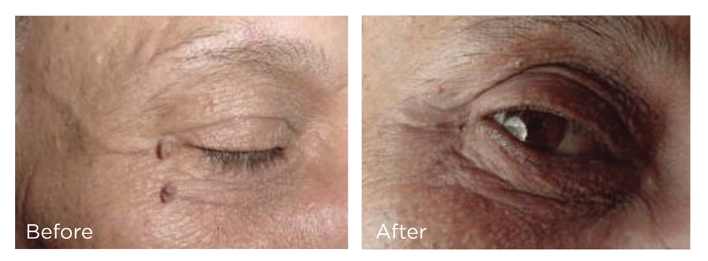 FreezePen-Before-and-Afters-eye-2-v3-web