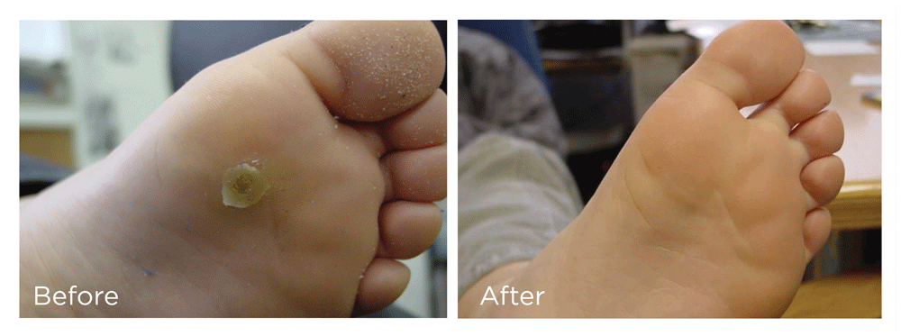 FreezePen-Before-and-Afters-foot-v3-web